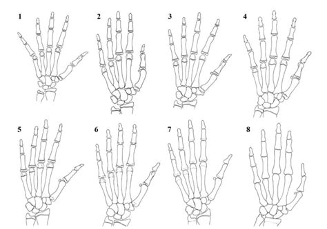 sanders maturity scale  bone age growing spine blog
