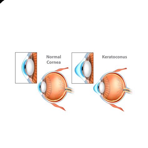 Managing Keratoconus With Collagen Crosslinking CXL At Nexus Clinic