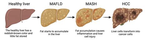 Novel Treatment Strategies For Fatty Liver Related Cancer Reality Or Fantazy Columbia