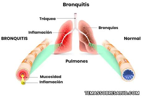 Bronquitis Obstructiva en los Niños Causas Síntomas y Tratamiento