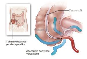 Akut Apandisit Nedenleri Ve Belirtileri Sa L K Hep Sa L K
