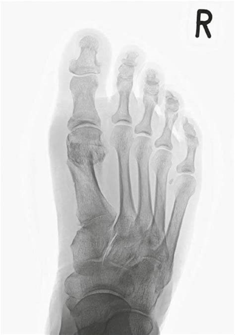 Hallux valgus Orthopädie Zentrum Arabellapark München