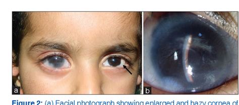 Figure 1 From Anterior Segment Dysgenesis And Secondary Glaucoma In