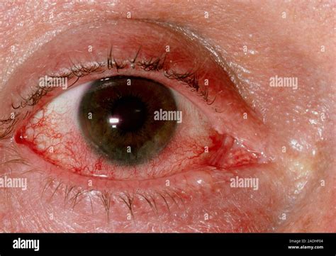 Infecci N Ocular Close Up De Un Ojo Afectado Por Conjuntivitis V Rica