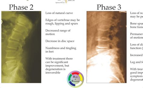 Phases of Spinal Degeneration Poster 24 x 36