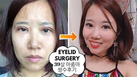 I Did Double Eyelid Surgery In Korea Incl Days Recovery Process