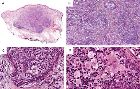 Histopathologic Features Of Cutaneous Lymphadenoma A Scanning View Of