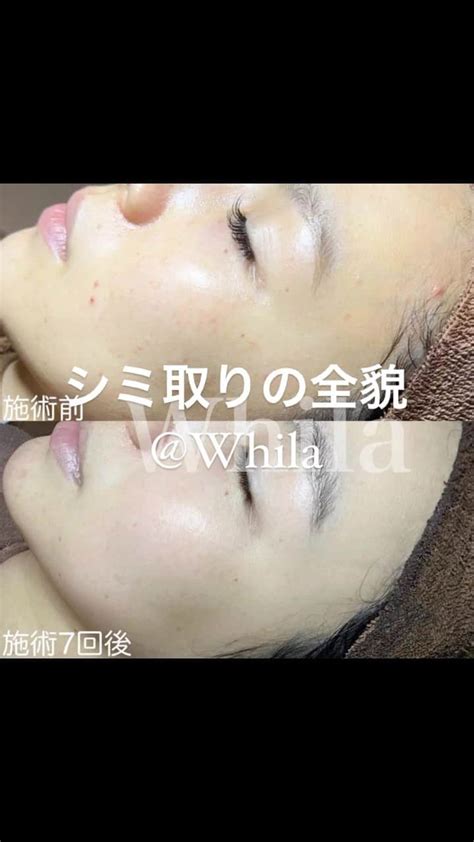 赤松悠実さんのインスタグラム動画 赤松悠実instagram 「ホワラのシミ取り 全貌😳👏 ️ Whila My 頑張ってリールとか