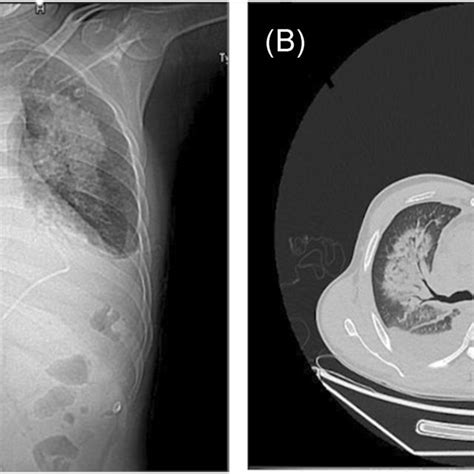 Preprocedural Chest Xray And Computed Tomography A Preoperative