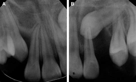 Periapical Radiographs Indicating Two Impacted Canines At Different