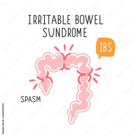 Irritable Bowel Syndrome Illustration Of A Spasm On The Gut Vector