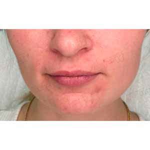 Контурная пластика губ - Увеличение губ гиалуроновой кислотой ...