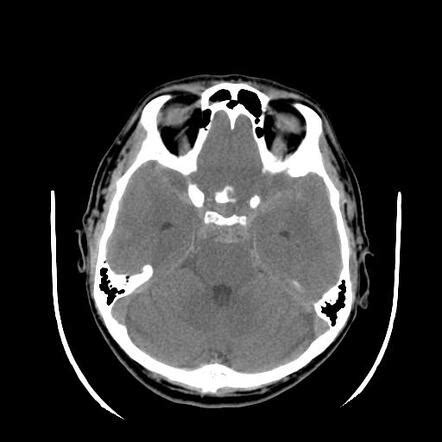 Subarachnoid Haemorrhage Radiology Case Radiopaedia Org