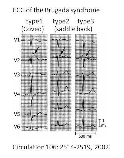 Brugada Syndrome The Clinical Advisor