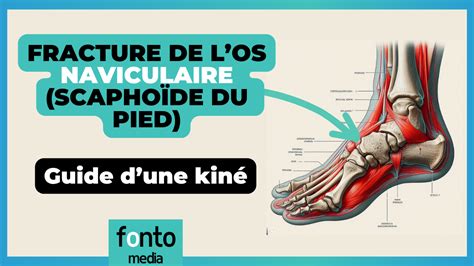 Fracture De Los Naviculaire Scaphoïde Au Pied Guide Dune Kiné