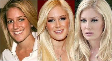 Heidi Montag Plastic Surgery | Back Scoop Surgery Before And After
