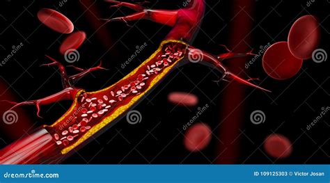 3d Illustration of Blocked Blood Vessel - Artery with Cholesterol ...