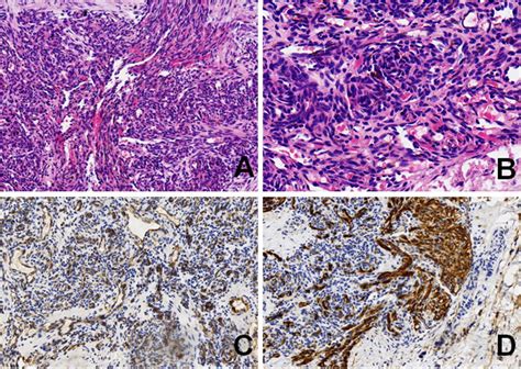 Photomicrograph Showed Irregular Spindle Tumor Cell Nodules In The