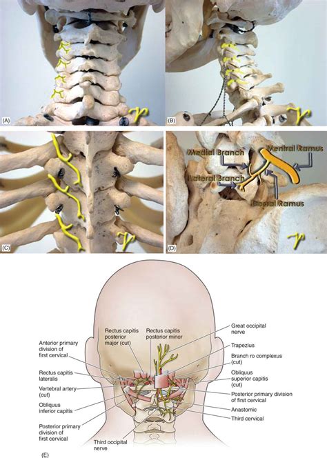 Facet Joint Nerve Block Injection