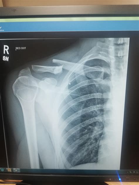 Broke my collar bone, does that mean I'm a proper mountain biker now