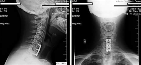 Cervical Fusion Recovery TImes?- Mtbr.com