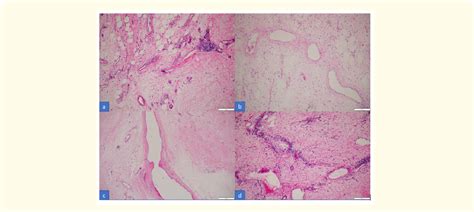 Figure 1 From Massive Localized Lymphedema In A Morbidly Obese Patient