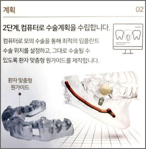 네비게이션임플란트 유앤아이치과의원 압구정