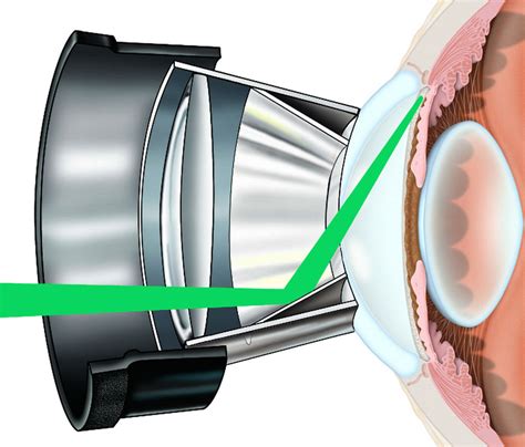 Trabeculoplastia selectiva con láser