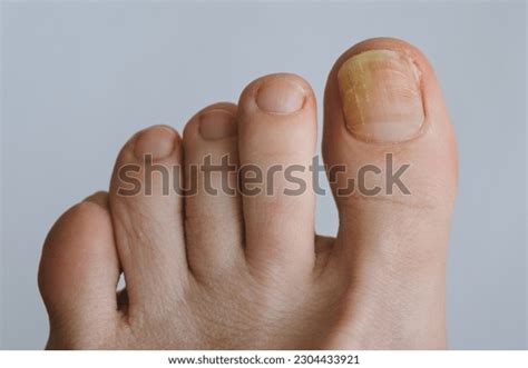 Foot Affected By Onychomycosis Photos Images Pictures Shutterstock