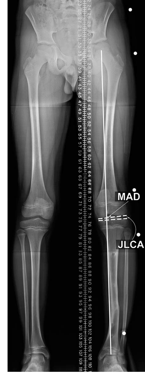 Assessment Of Lower Limb Alignment Supine Fluoroscopy Compared With A