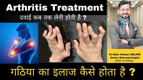 गठिया का इलाज कैसे होता है Arthritis Treatment Rheumatologist