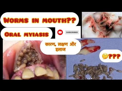 Worms In Mouth Oral Myiasis How To Treat Sign Symptoms Causes Oral