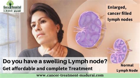 Lymph Node Cancer Treatment In Madurai | Best Cancer Centre In Tamil