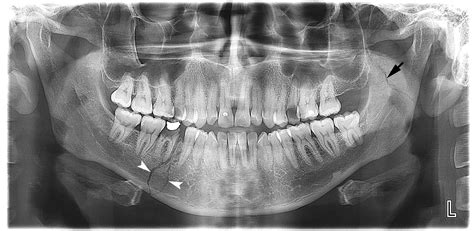 Mandible Fracture X Ray