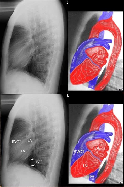 lateral view chest xray basic cxr  common vein