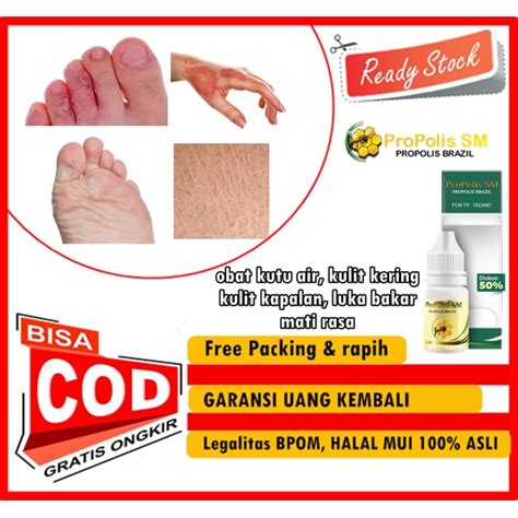 Jual Propolis Sm Obat Gatal Gatel Tradisional Obat Kutu Air Kulit