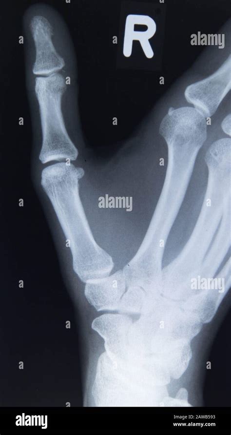 Broken Hand X Ray Hi Res Stock Photography And Images Alamy