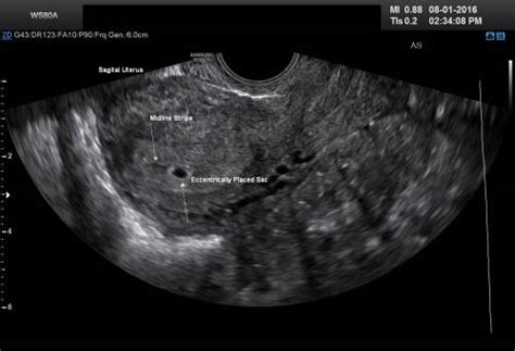 4 Weeks Pregnant Ultrasound Pictures And Description