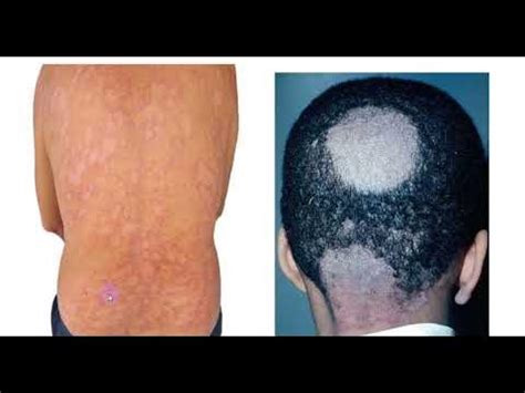 Dermatophytosis 1 - YouTube