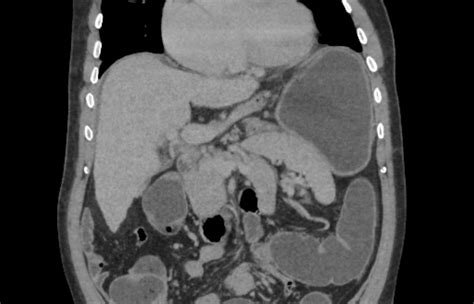 Mesentero Axial Gastric Volvulus Image Radiopaedia Org