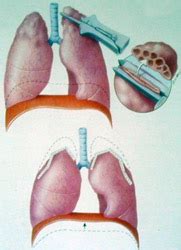 Lung Volume Reduction Surgery ScienceDirect, 44% OFF