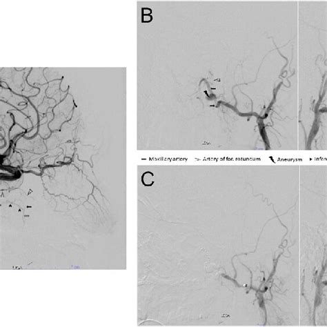 A Left Internal Carotid Artery Digital Subtraction Angiogram Late