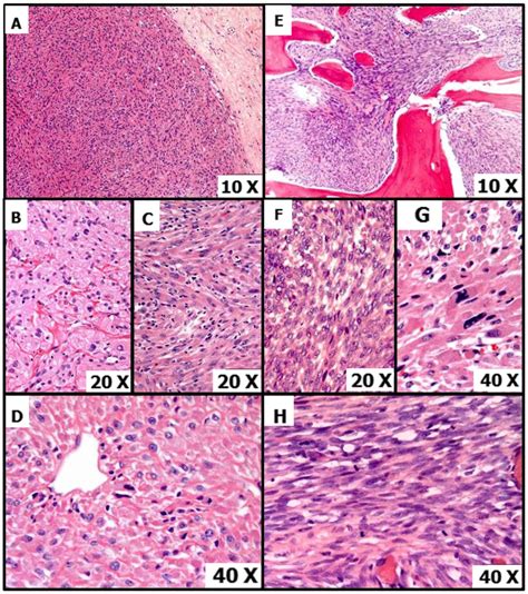 Primary Malignant Perivascular Epithelioid Cell Neoplasm PEComa Of