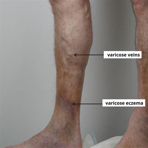 Is Varicose Eczema Serious The VeinCare Centre