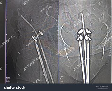 Brachytherapy: Over 17 Royalty-Free Licensable Stock Photos | Shutterstock