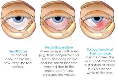 Uveitis Vs Conjunctivitis