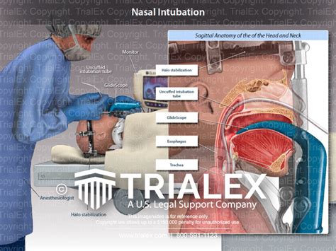 Nasal Intubation - TrialExhibits Inc.