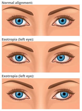 Strabismus And Crossed Eyes Explained - AllAboutVision.com