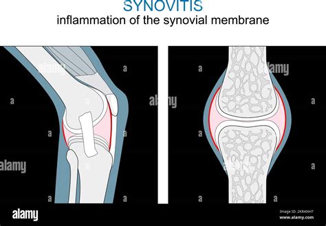 Types of Synovitis. inflammation of the synovial membrane of a Knee and ...