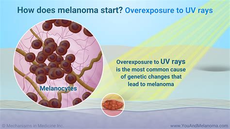 Slide Show Genetic Mutations And Melanoma